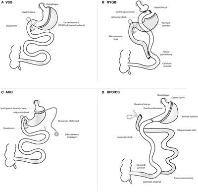 Metabolic Surgery to Treat Obesity in Diabetic Kidney Disease, Chronic Kidney Disease, and End-Stage Kidney Disease; What Are the Unanswered Questions?